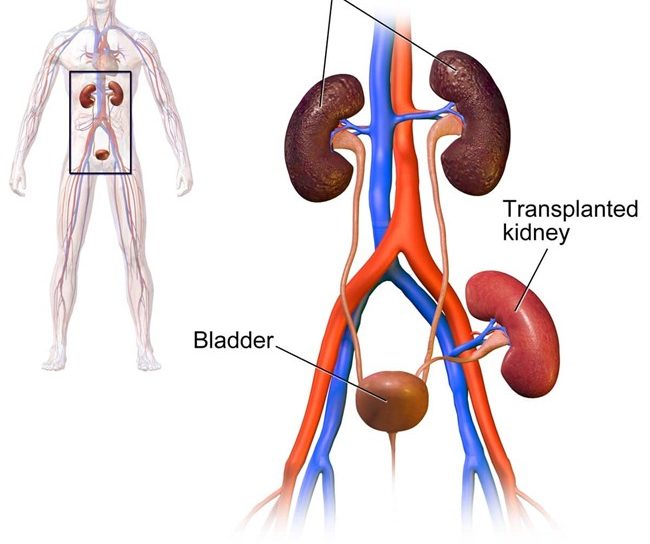 Kidney-Stone