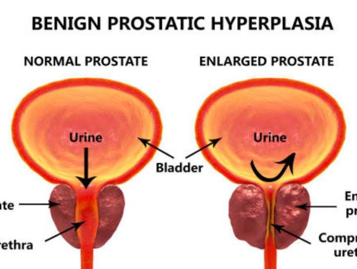 Enlarged-prostate